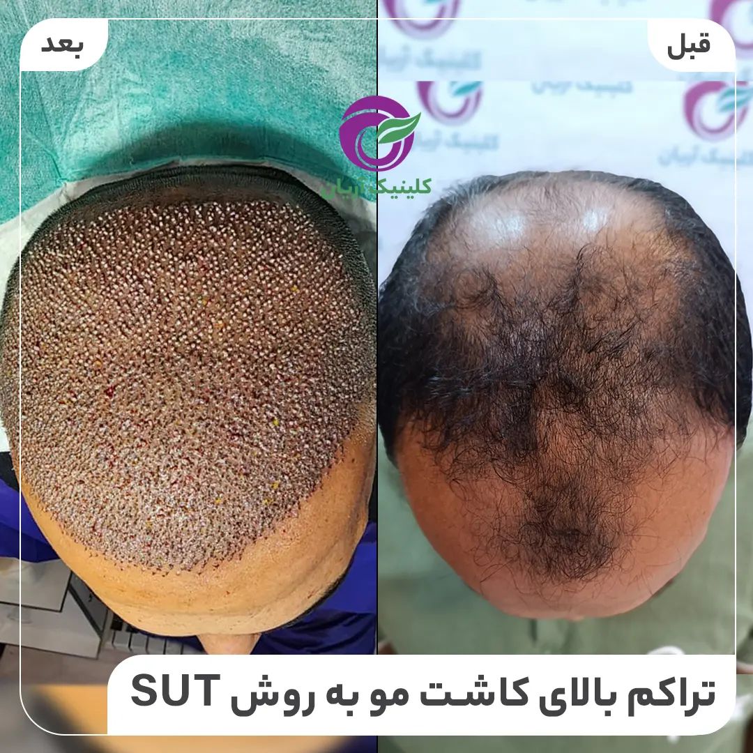 گالری کاشت مو 